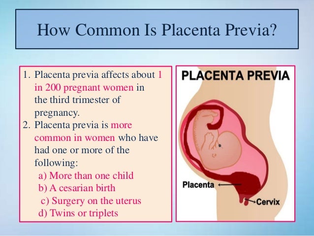 Low Lying Placenta Travel By Car Low Lying Placenta Travel By Car