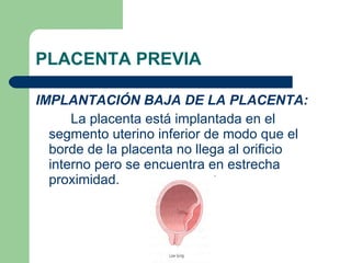PLACENTA PREVIA <ul><li>IMPLANTACIÓN BAJA DE LA PLACENTA: </li></ul><ul><li>La placenta está implantada en el segmento ute...
