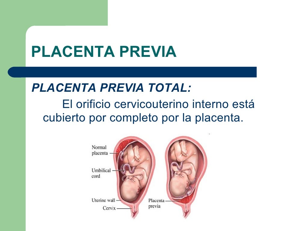 Placenta previa