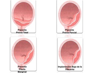 Placenta            Placenta
Previa Total       Previa Parcial




 Placenta      Implantación Baja de la
  Previa              Placenta
 Marginal
 