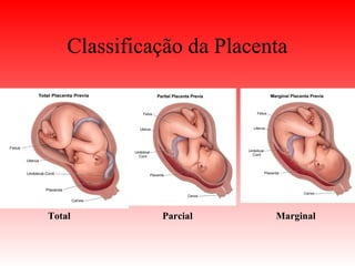 Classificação da Placenta
Total Parcial Marginal
 