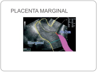 PLACENTA MARGINAL
 