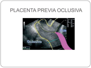 PLACENTA PREVIA OCLUSIVA
 