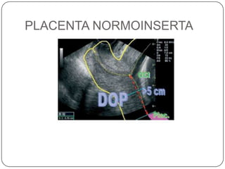 PLACENTA NORMOINSERTA
 