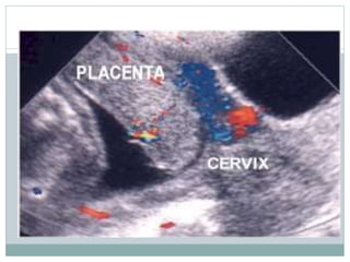 Signos y
síntomas
Placenta
Previa
Separación
marginal
Despren
moderado
Despren
grave
Rotura
uterina
Hemorragia Leve a
grav...