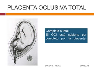 PLACENTA OCLUSIVA TOTAL
Completa o total.
El OCI está cubierto por
completo por la placenta.
27/02/2015PLACENTA PREVIA.
 