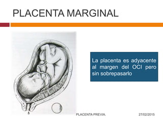 PLACENTA MARGINAL
La placenta es adyacente
al margen del OCI pero
sin sobrepasarlo
27/02/2015PLACENTA PREVIA.
 