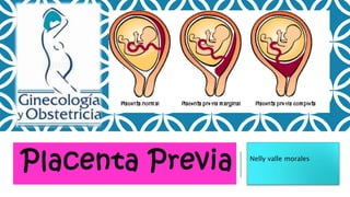 Placenta Previa Nelly valle morales
 