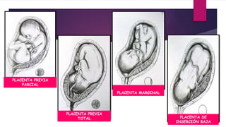Una placenta oclusiva parcial al
comenzar el trabajo de parto
puede transformarse en una
marginal por dilatación del cuello.
PLACENTA PREVIA
PARCIAL
PLACENTA PREVIA
TOTAL
PLACENTA MARGINAL
PLACENTA DE
INSERCIÓN BAJA
 
