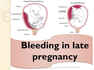 2- Ante partum Hemorrhage:
Bleeding in late pregnancy
(After 20 weeks Gestation)
 Definition
 Antepartum hemorrhage is d...