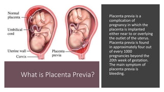 What is Placenta Previa?
Placenta previa is a
complication of
pregnancy in which the
placenta is implanted
either near to or overlying
the outlet of the uterus.
Placenta previa is found
in approximately four out
of every 1000
pregnancies beyond the
20th week of gestation.
The main symptom of
placenta previa is
bleeding.
 