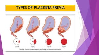 TYPES OF PLACENTA PREVIA
 