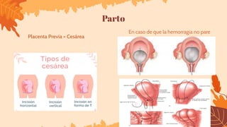 Parto
Placenta Previa = Cesárea
En caso de que la hemorragia no pare
 