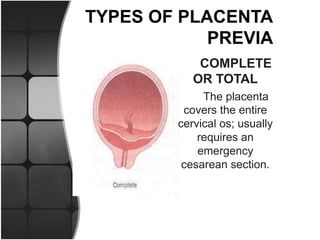 PLACENTA PREVIA.ppt.pdf