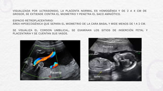 PLACENTA PREVIA y desprendimiento pl.pdf