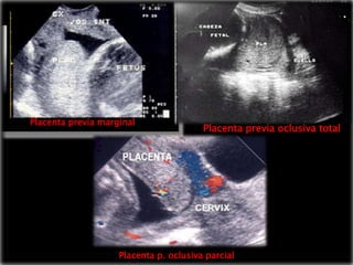 OCI



Placenta previa marginal
                                        Placenta previa oclusiva total




                    Placenta p. oclusiva parcial
 