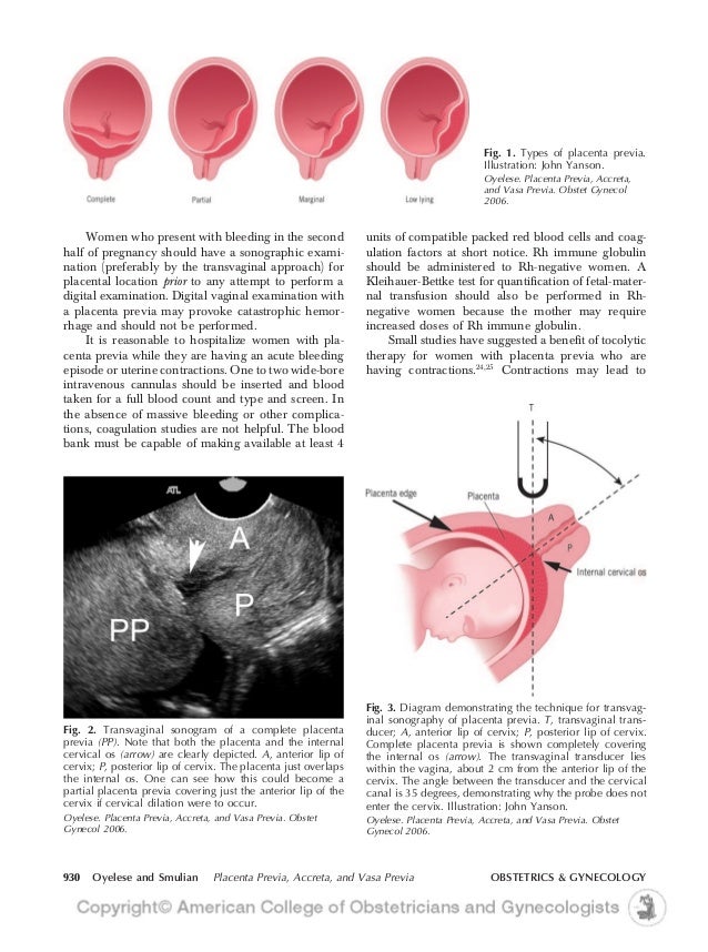 Placenta previa, accreta, etc