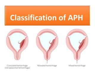 placenta Previa (APHge).pdf