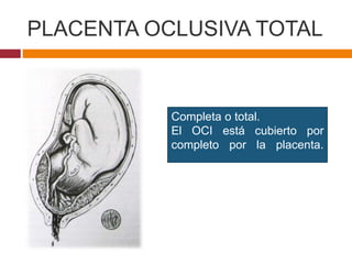 PLACENTA OCLUSIVA TOTAL
Completa o total.
El OCI está cubierto por
completo por la placenta.
 