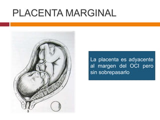PLACENTA MARGINAL
La placenta es adyacente
al margen del OCI pero
sin sobrepasarlo
 