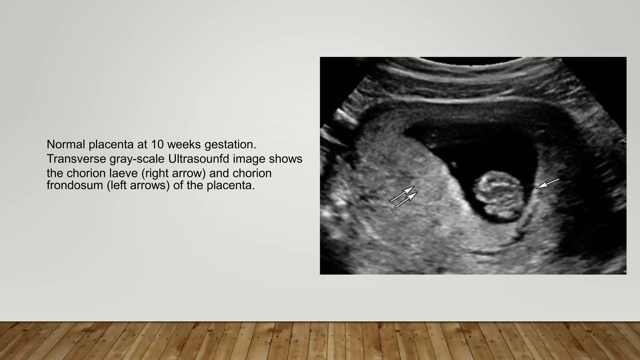 Normal placenta at 10 weeks gestation.
Transverse gray-scale Ultrasounfd image shows
the chorion laeve (right arrow) and chorion
frondosum (left arrows) of the placenta.
 