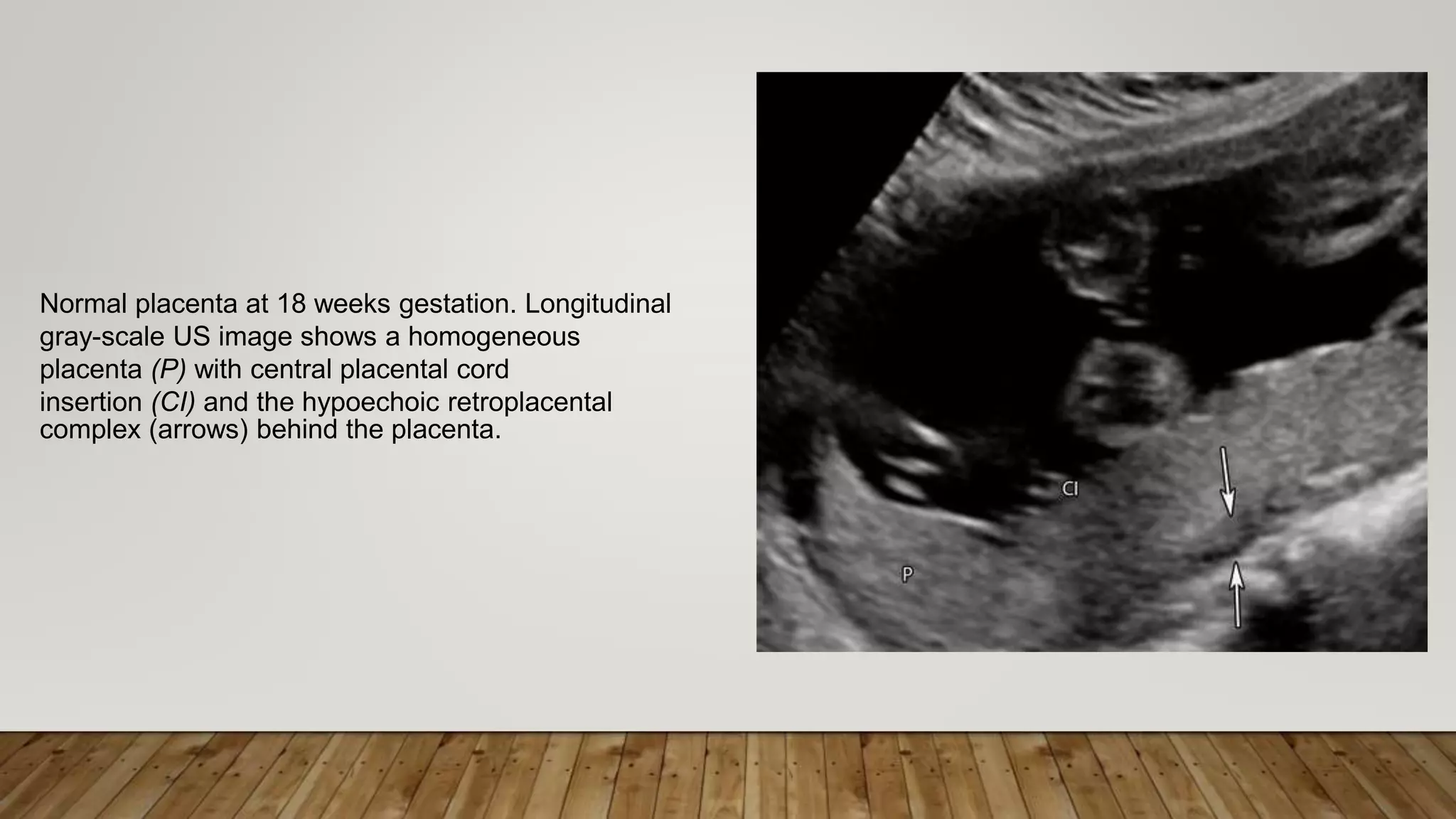 Normal placenta at 18 weeks gestation. Longitudinal
gray-scale US image shows a homogeneous
placenta (P) with central placental cord
insertion (CI) and the hypoechoic retroplacental
complex (arrows) behind the placenta.
 