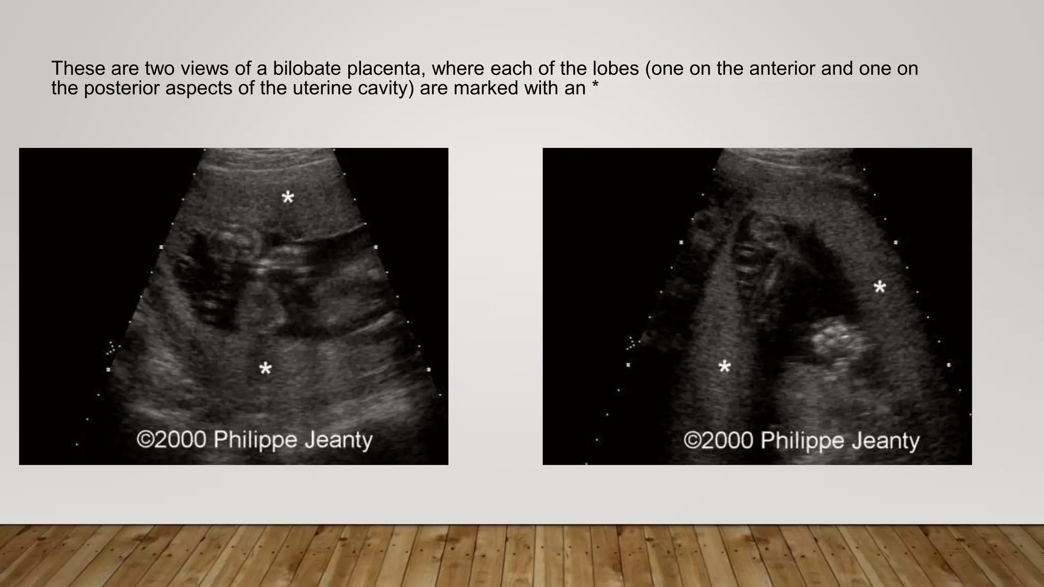 These are two views of a bilobate placenta, where each of the lobes (one on the anterior and one on
the posterior aspects of the uterine cavity) are marked with an *
 