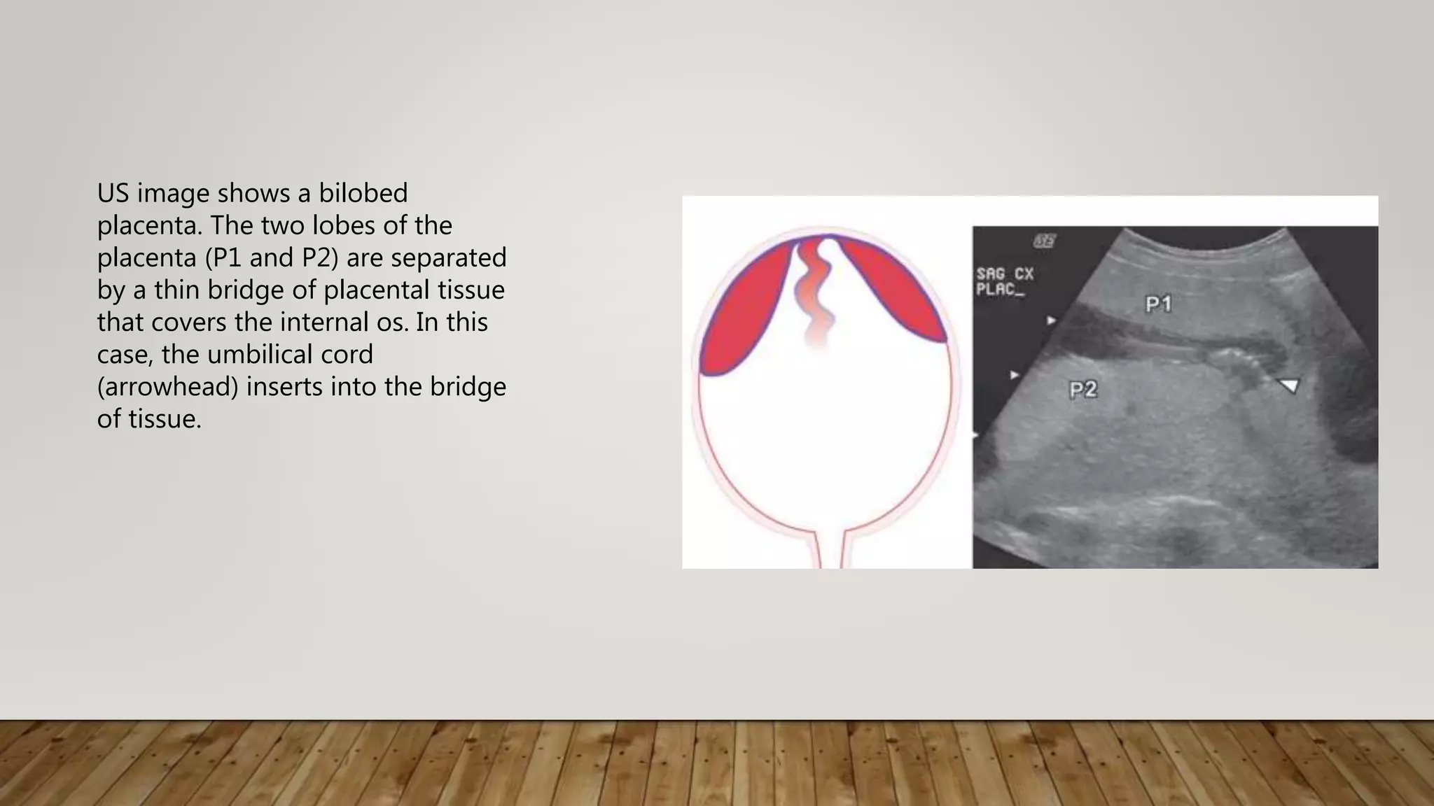 US image shows a bilobed
placenta. The two lobes of the
placenta (P1 and P2) are separated
by a thin bridge of placental tissue
that covers the internal os. In this
case, the umbilical cord
(arrowhead) inserts into the bridge
of tissue.
 