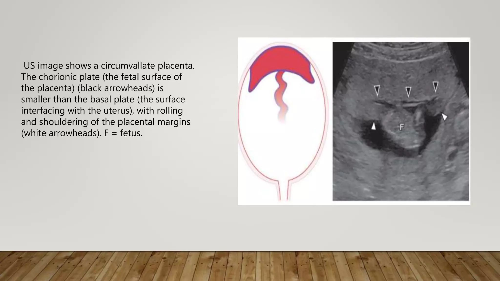 US image shows a circumvallate placenta.
The chorionic plate (the fetal surface of
the placenta) (black arrowheads) is
smaller than the basal plate (the surface
interfacing with the uterus), with rolling
and shouldering of the placental margins
(white arrowheads). F = fetus.
 
