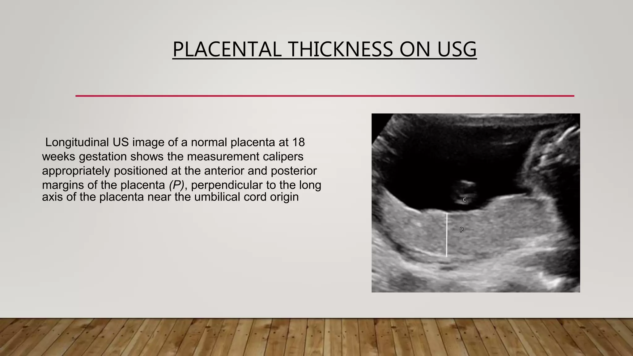 PLACENTAL THICKNESS ON USG
Longitudinal US image of a normal placenta at 18
weeks gestation shows the measurement calipers
appropriately positioned at the anterior and posterior
margins of the placenta (P), perpendicular to the long
axis of the placenta near the umbilical cord origin
 