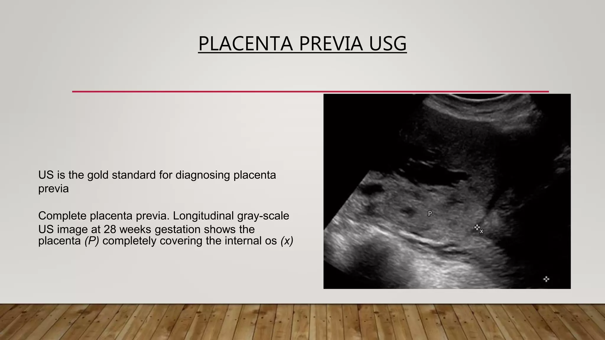 PLACENTA PREVIA USG
US is the gold standard for diagnosing placenta
previa
Complete placenta previa. Longitudinal gray-scale
US image at 28 weeks gestation shows the
placenta (P) completely covering the internal os (x)
 