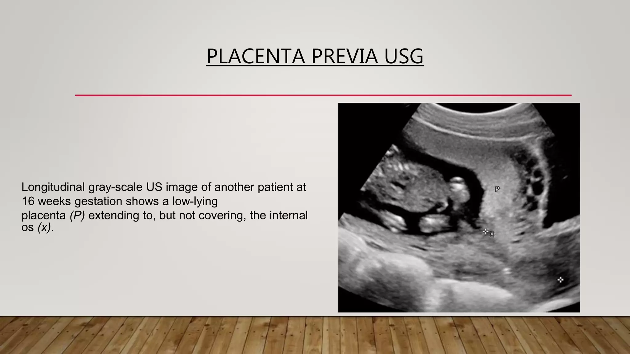 PLACENTA PREVIA USG
Longitudinal gray-scale US image of another patient at
16 weeks gestation shows a low-lying
placenta (P) extending to, but not covering, the internal
os (x).
 