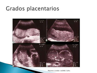 Placenta y cordón. LUCERO. Cafici. 
 