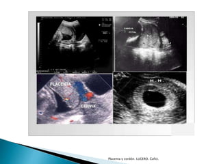 Placenta y cordón. LUCERO. Cafici. 
 