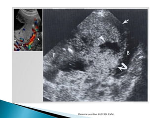 Placenta y cordón. LUCERO. Cafici. 
 