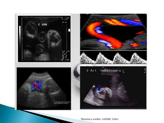 Placenta y cordón. LUCERO. Cafici. 
 