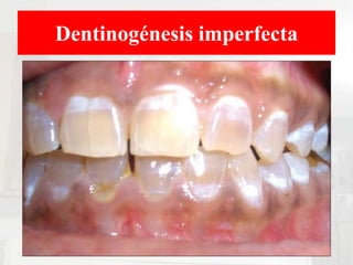 Dentinogénesis imperfecta
 