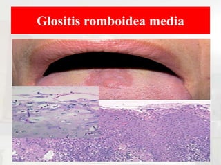Glositis romboidea media
 