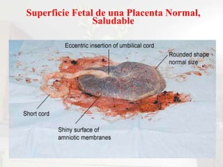Placenta Circunvalada
 