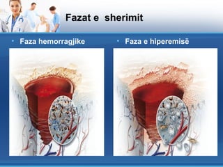 Fazat e sherimit

• Faza hemorragjike    • Faza e hiperemisë
 