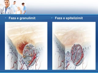 • Faza e granulimit   • Faza e epitelizimit
 