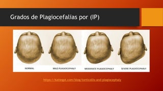 Grados de Plagiocefalias por (IP)
https://katiegpt.com/blog/torticollis-and-plagiocephaly
 