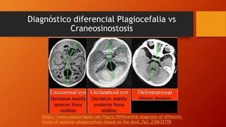 Diagnóstico diferencial Plagiocefalia vs
Craneosinostosis
https://www.researchgate.net/figure/Differential-diagnosis-of-different-
forms-of-anterior-plagiocephaly-based-on-the-skull_fig1_230632778
 