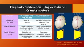 Diagnóstico diferencial Plagiocefalia vs
Craneosinostosis
Indicador PLAGIOCEFALIAS
POSICIONALES
CRANEOSINOSTOSIS
Fontanelas Abiertas Cerradas precozmente
Raíz nasal Centrada Desviada en casos
severos
Pabellón auricular Desviación antero-
inferior del pabellón
ipsilateral
Desviación posterior del
pabellón auricular
Forma del cráneo Paralelogramo Trapezoidal
Otros Aplanamiento y alopecia
occipito-parietal
ipsilateral
Cresta ósea palpable
sobre sutura lambdoidea
https://radiologyassistant.nl/pedi
atrics/hip/craniosynosthosis
 