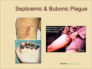 Septicemic & Bubonic Plague
Source: CDC NVBID
 