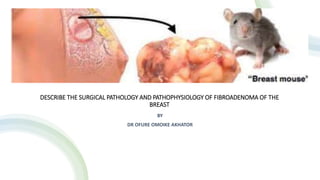 DESCRIBE THE SURGICAL PATHOLOGY AND PATHOPHYSIOLOGY OF FIBROADENOMA OF THE
BREAST
BY
DR OFURE OMOIKE AKHATOR
 