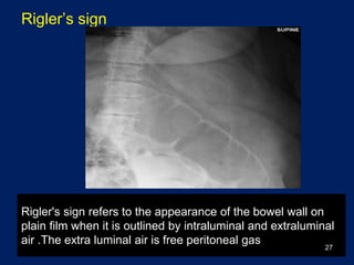 Plain picture in acute abdomen | PPTX