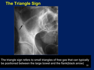 Plain picture in acute abdomen | PPTX