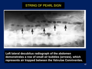 Plain picture in acute abdomen | PPTX