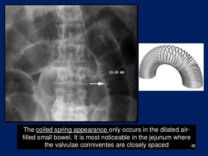 Plain picture in acute abdomen